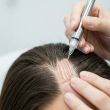 Hair Restoration